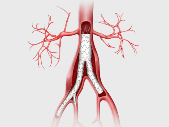 Endovascular Aortoiliac Workshop - Artivion