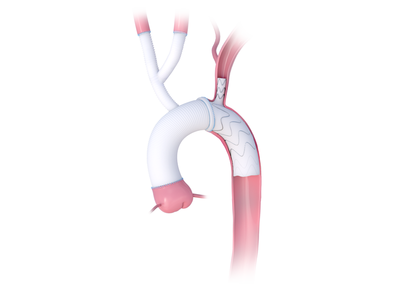 products-in-aorta_Neo-EDE_RGB_800x600