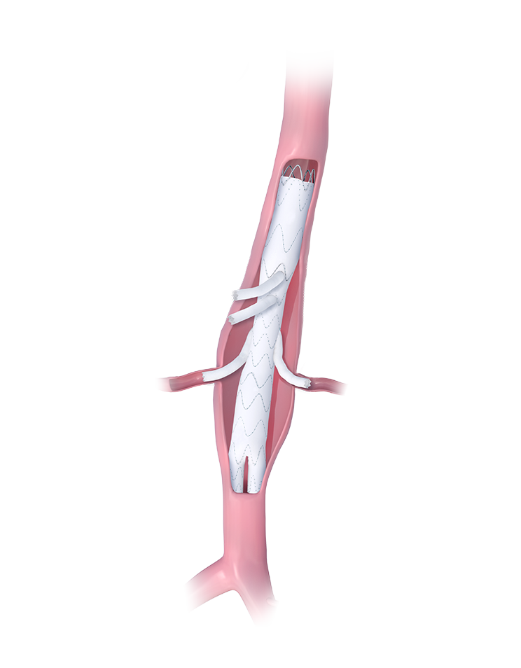 products-in-anatomy-EDE-Multibranch-aneurysm